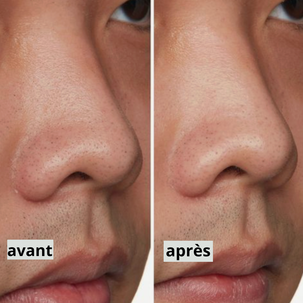 Patchs   nose  – Soin Nuit Purifiant